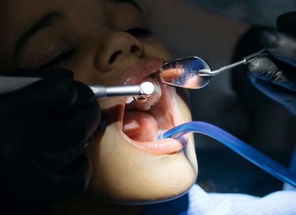 Karies bērnam: vai jāārstē piena zobi?